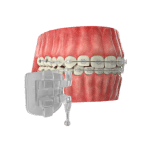 brackets estéticos