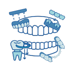 prótesis dental en alcoy